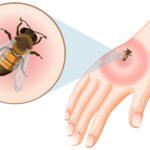 Bitės įgėlimas ir jo pasekmės