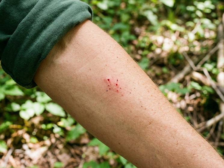 Gyvatės įkandimas: kaip atrodo, ką daryti ir kada kreiptis pagalbos